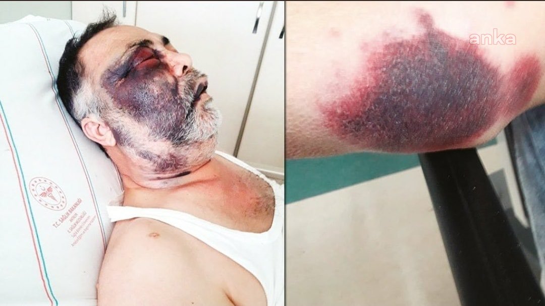 ANTALYA'DA DARBEDİLEN YÜZDE 90 ENGELLİ MÜMİN KARA HAYATINI KAYBETTİ
